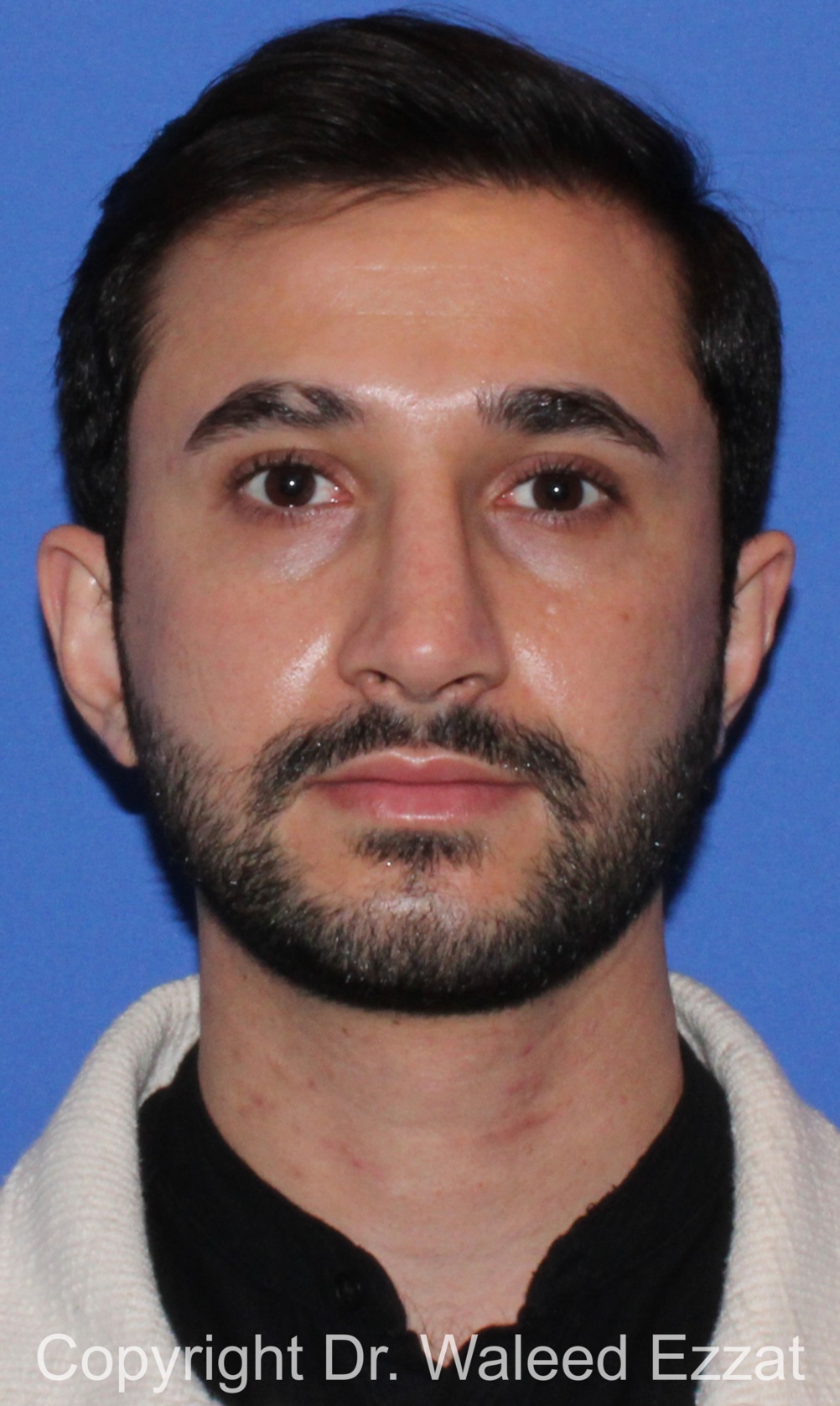 Mediterranean/Middle Eastern Rhinoplasty Patient Photo - Case 660 - after view-2