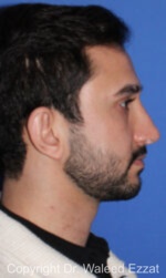Mediterranean/Middle Eastern Rhinoplasty - Case 660 - After