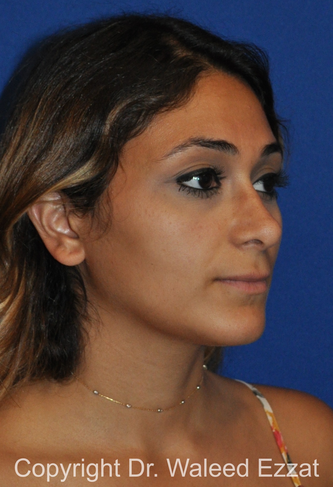 Mediterranean/Middle Eastern Rhinoplasty Patient Photo - Case 661 - after view-2