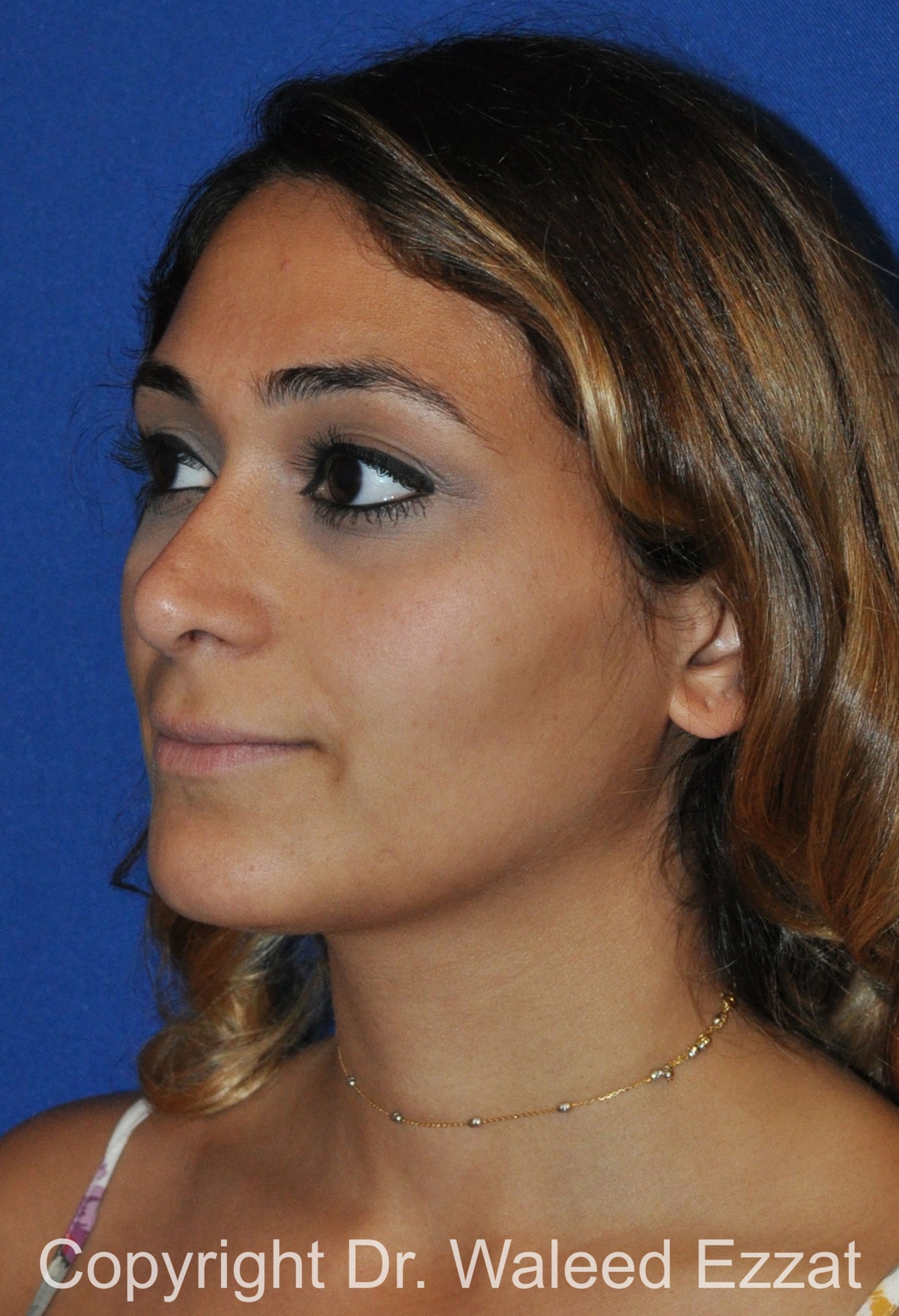 Mediterranean/Middle Eastern Rhinoplasty Patient Photo - Case 661 - after view-1