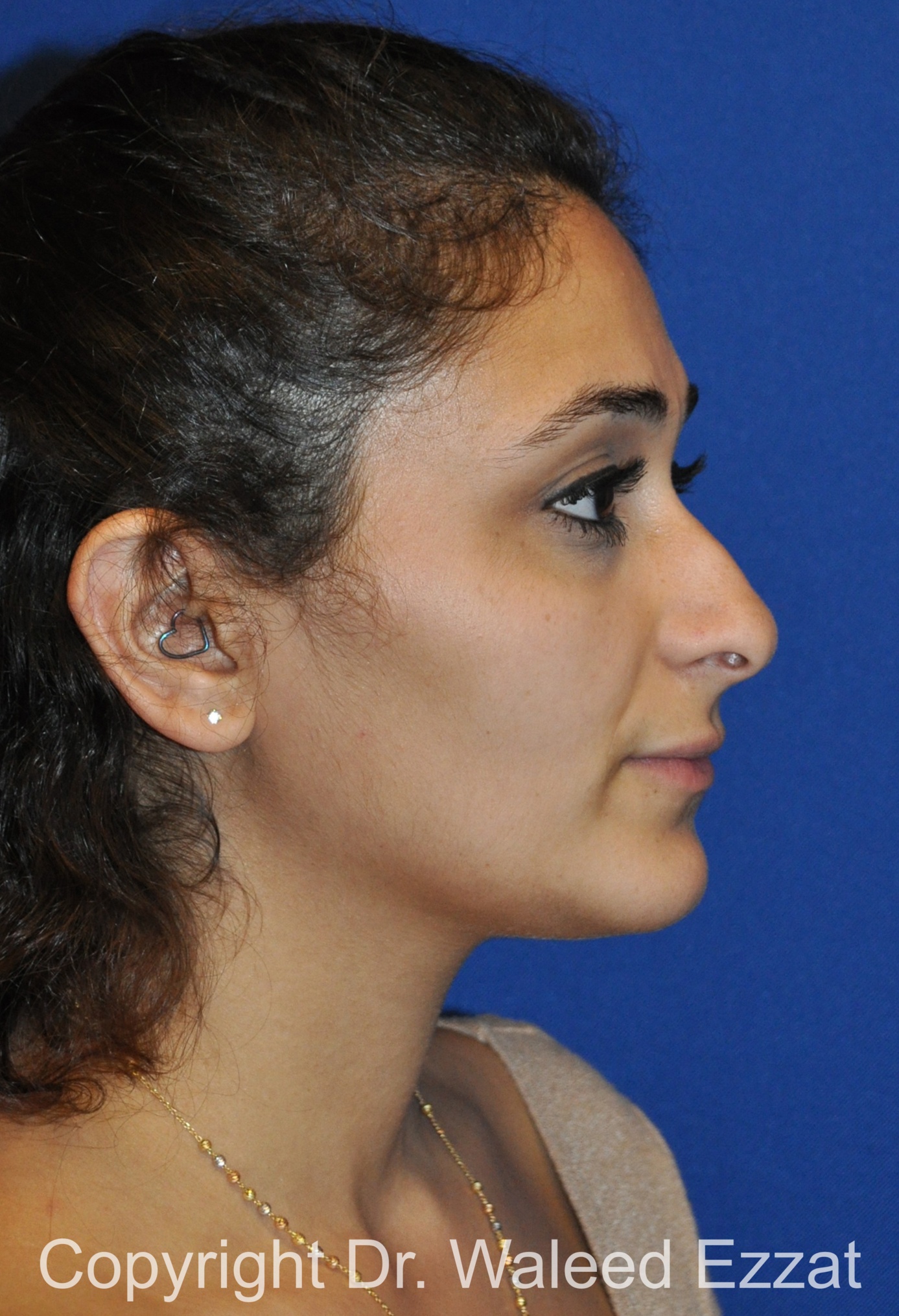 Mediterranean/Middle Eastern Rhinoplasty Patient Photo - Case 661 - before view-3