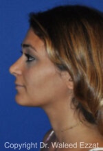 Mediterranean/Middle Eastern Rhinoplasty - Case 661 - After