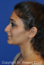 Mediterranean/Middle Eastern Rhinoplasty - Case 661 - Before