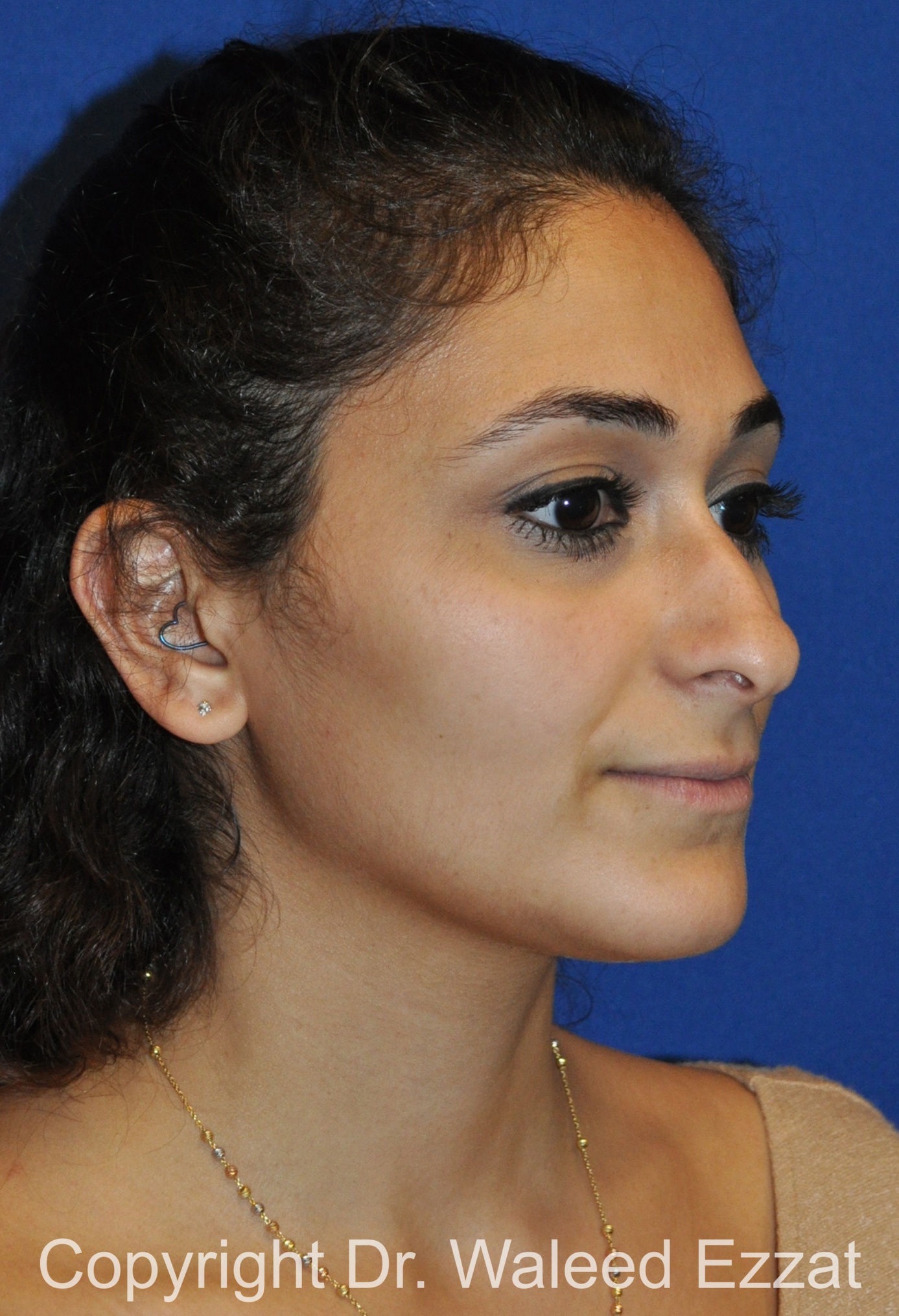 Mediterranean/Middle Eastern Rhinoplasty Patient Photo - Case 661 - before view-2