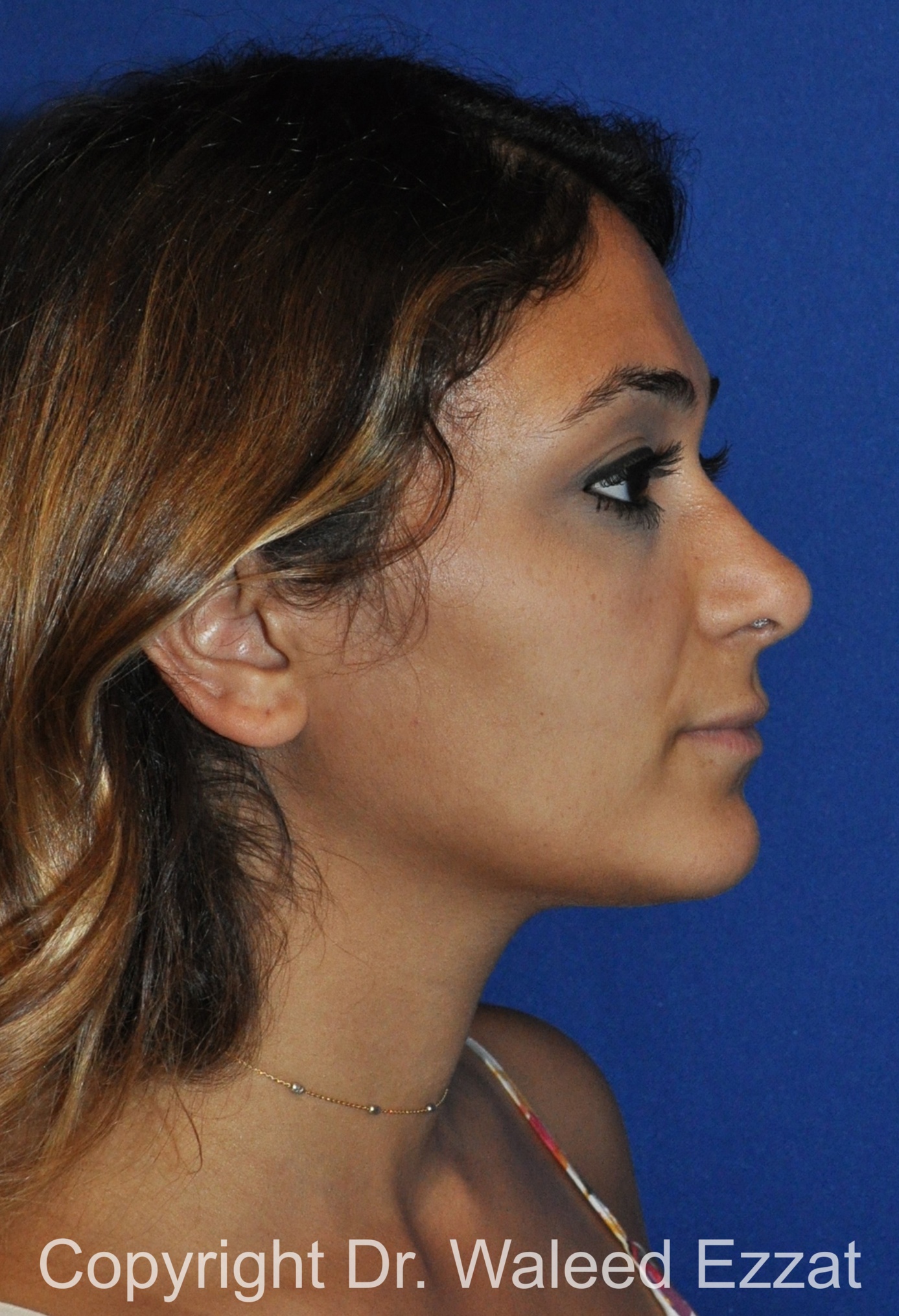 Mediterranean/Middle Eastern Rhinoplasty Patient Photo - Case 661 - after view-3