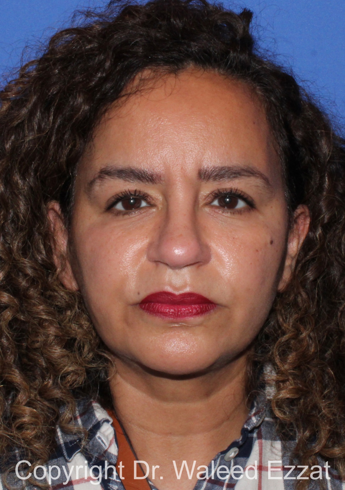 Mediterranean/Middle Eastern Rhinoplasty Patient Photo - Case 662 - after view-2