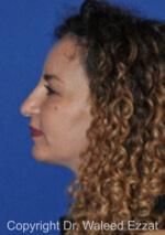 Mediterranean/Middle Eastern Rhinoplasty - Case 662 - Before