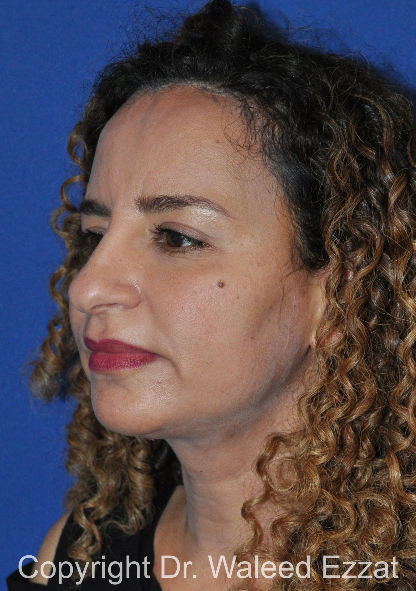 Mediterranean/Middle Eastern Rhinoplasty Patient Photo - Case 662 - before view-1