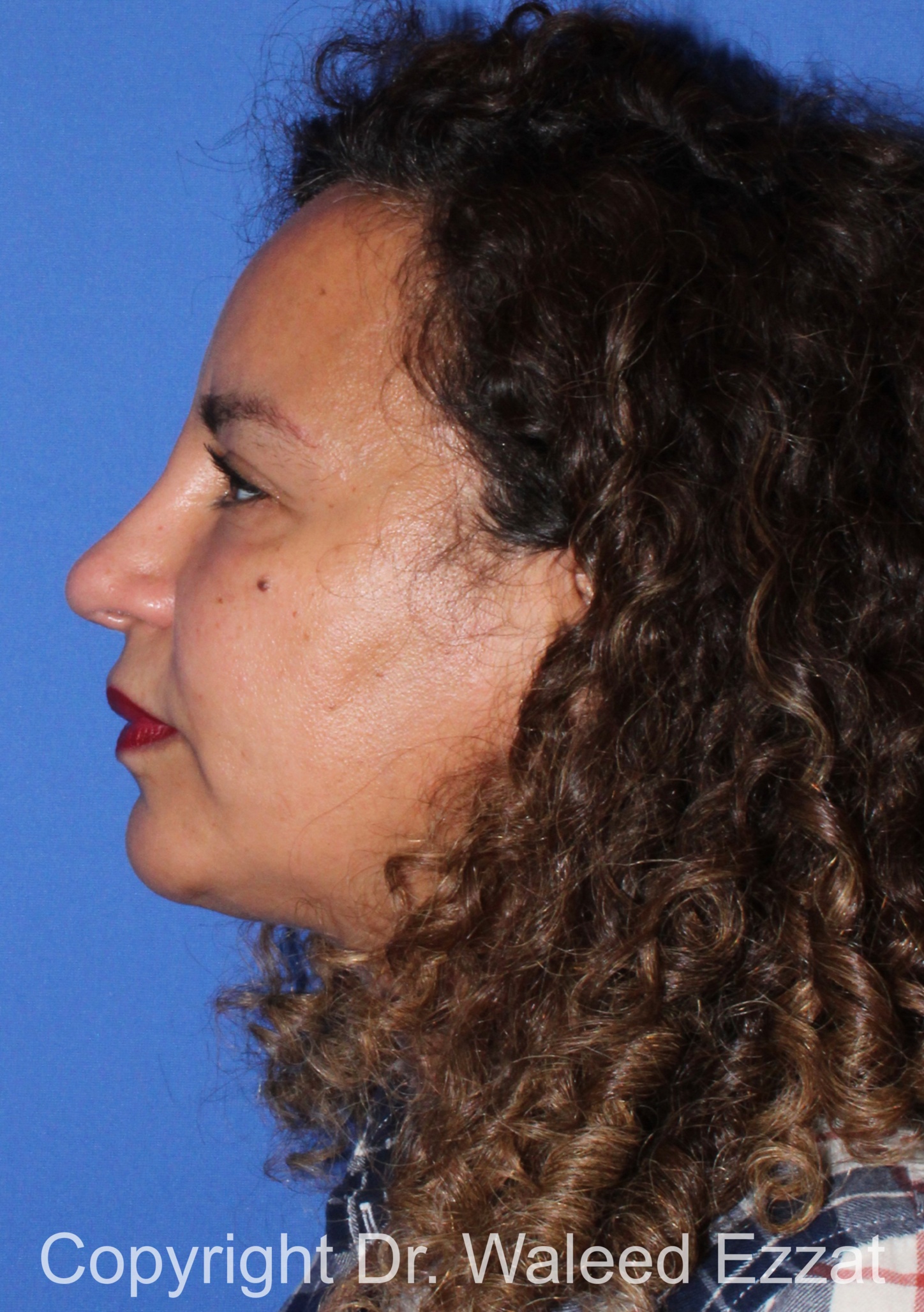 Mediterranean/Middle Eastern Rhinoplasty Patient Photo - Case 662 - after view