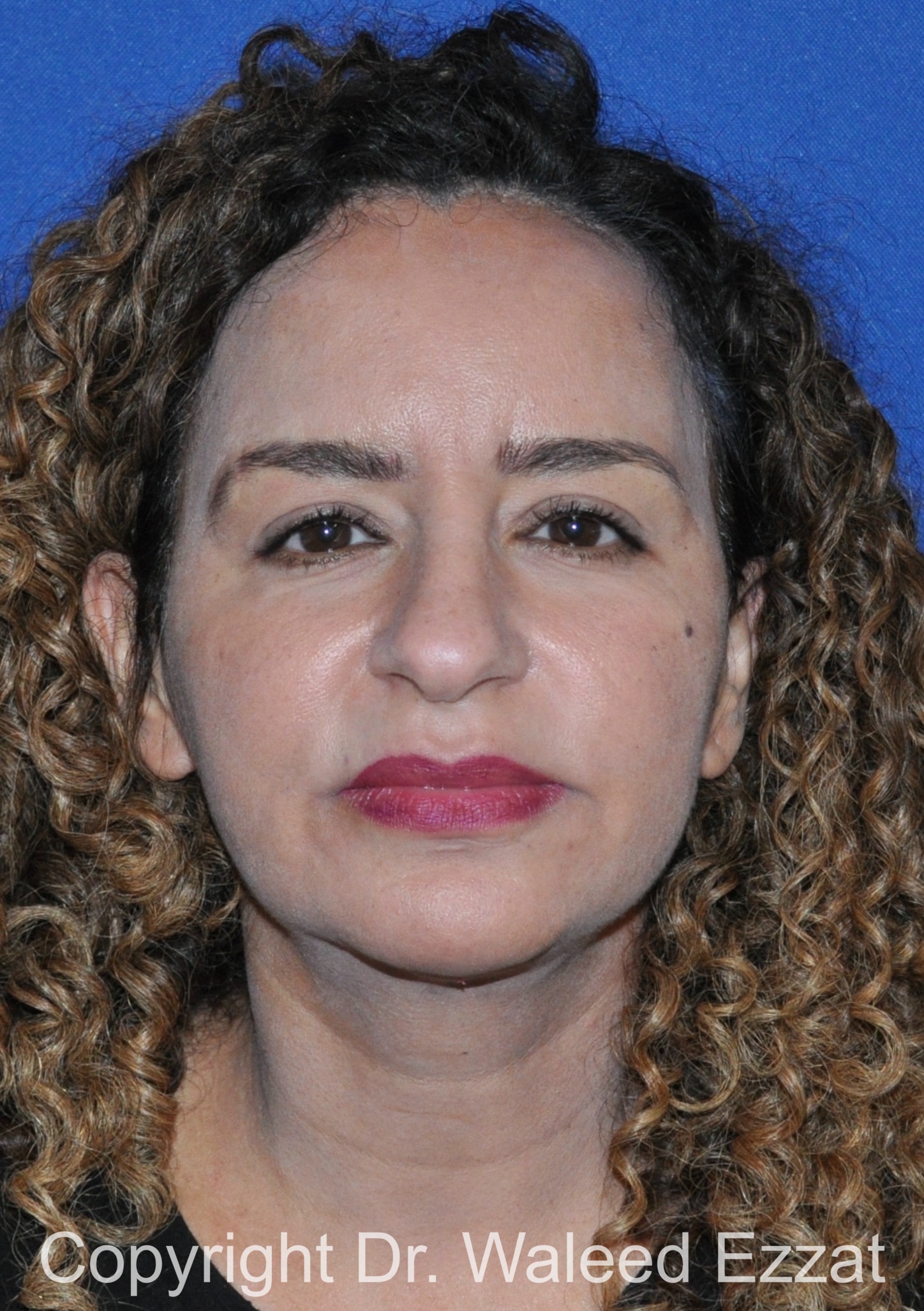 Mediterranean/Middle Eastern Rhinoplasty Patient Photo - Case 662 - before view-2