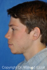 Reconstructive Rhinoplasty - Case 175 - After