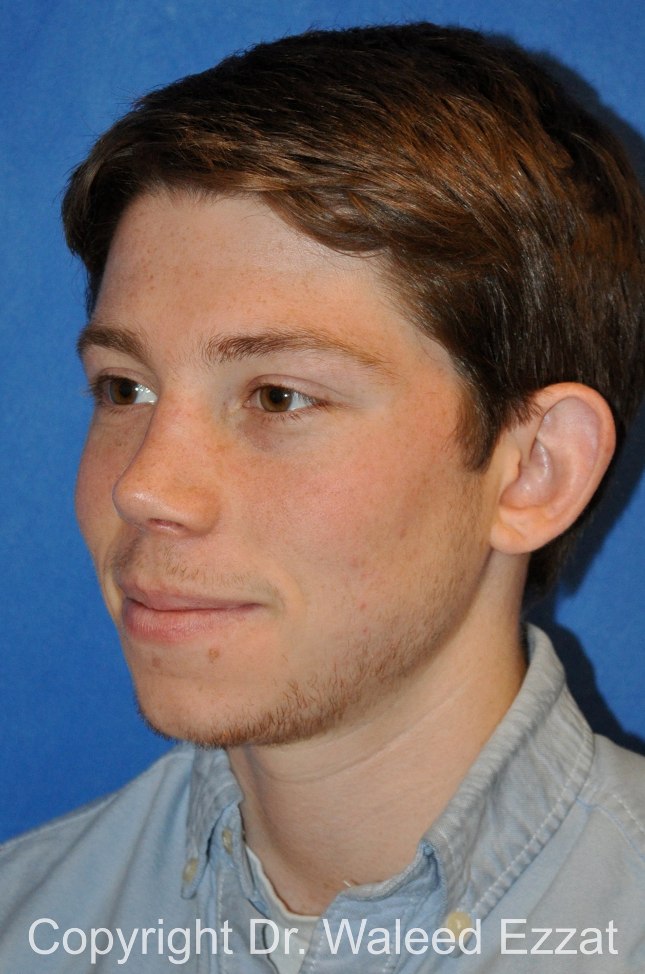 Reconstructive Rhinoplasty Patient Photo - Case 175 - after view-1