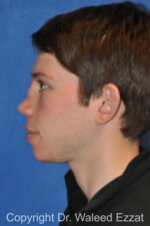 Reconstructive Rhinoplasty - Case 175 - Before