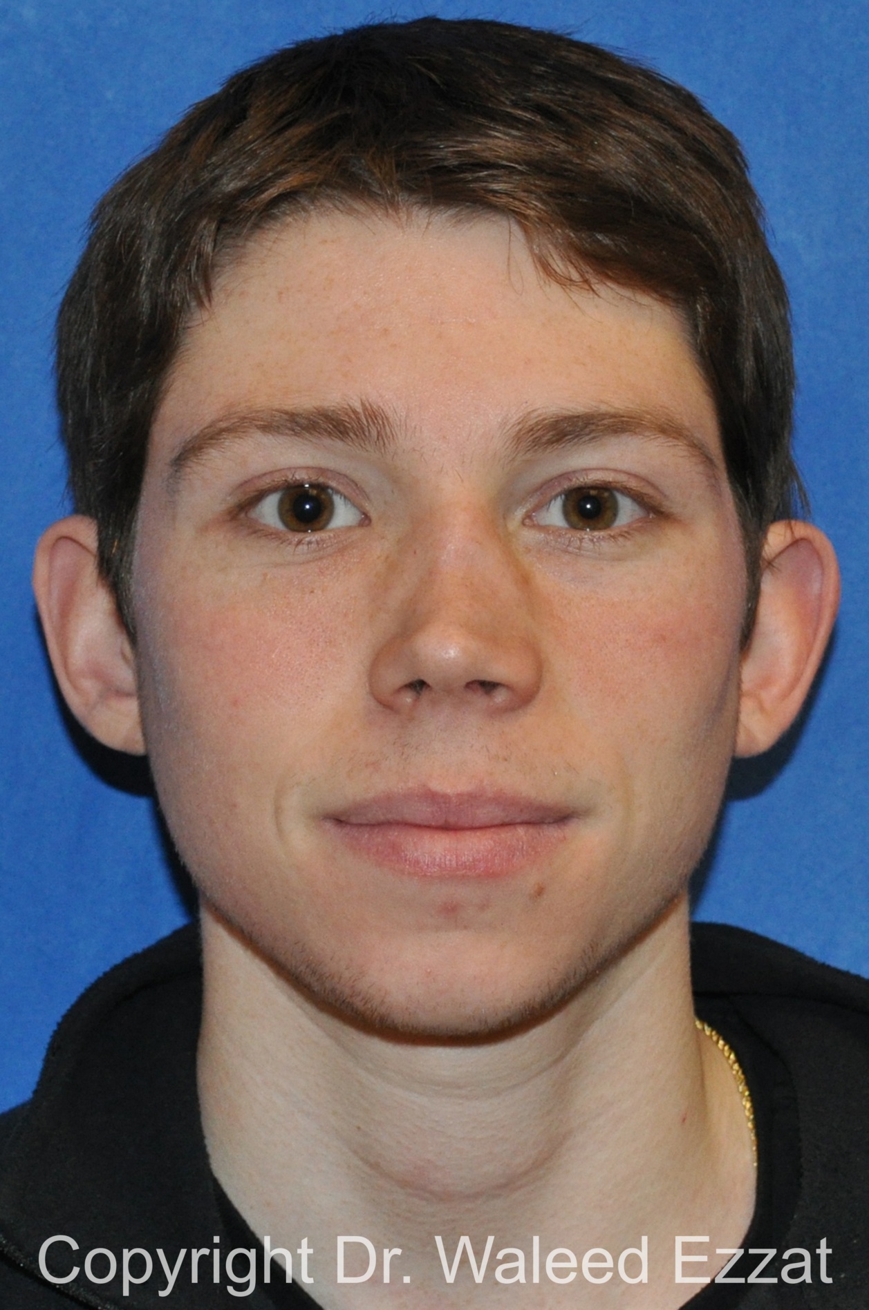 Reconstructive Rhinoplasty Patient Photo - Case 175 - before view-2