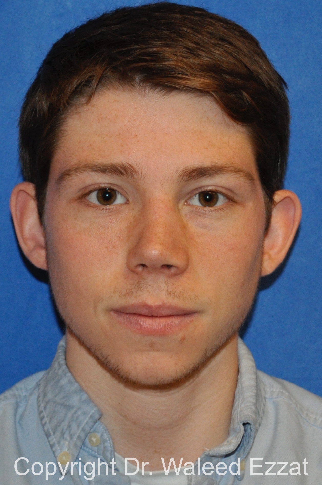 Reconstructive Rhinoplasty Patient Photo - Case 175 - after view-2