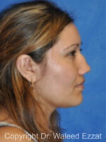 Reconstructive Rhinoplasty - Case 177 - Before