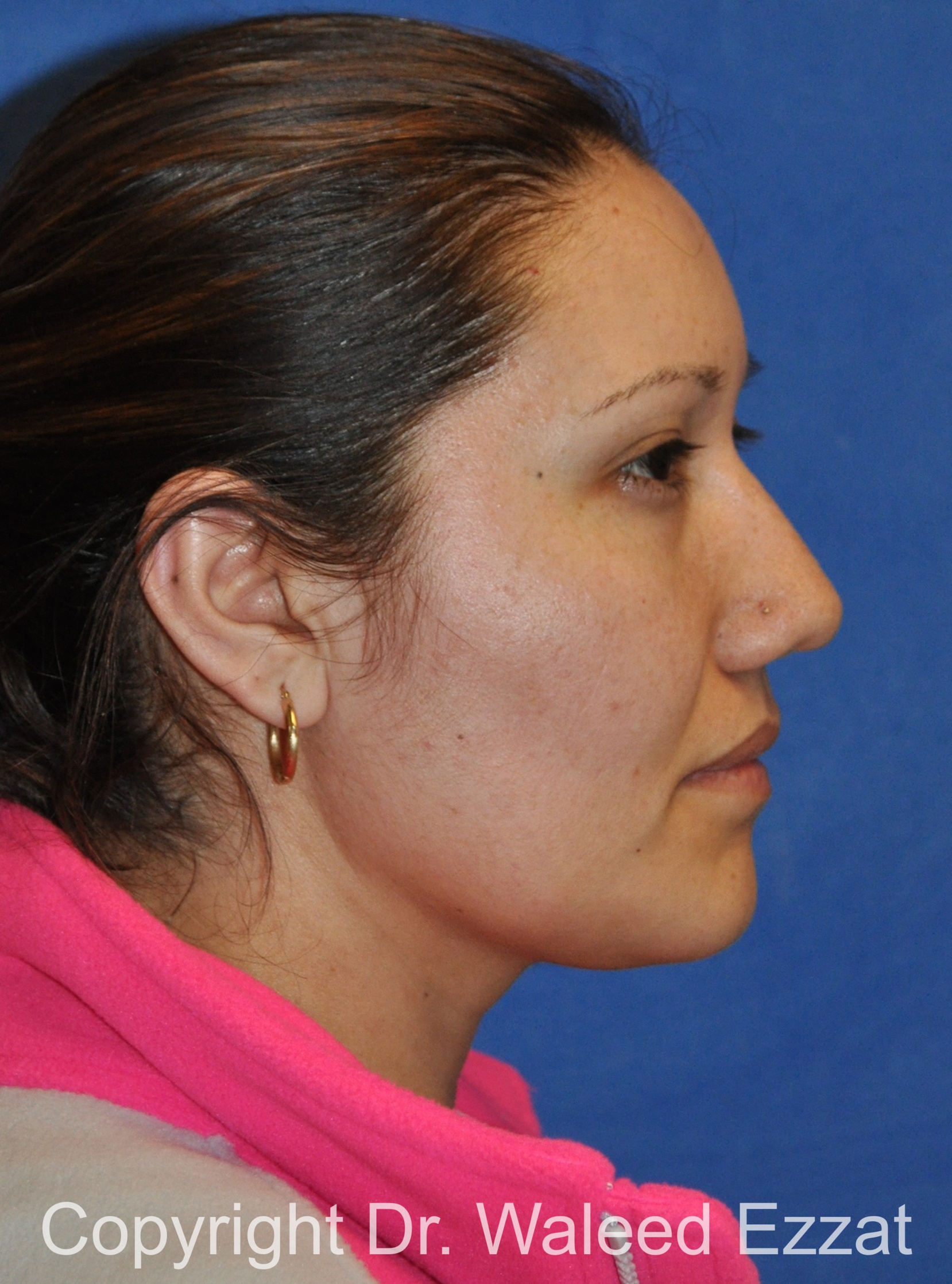 Reconstructive Rhinoplasty Patient Photo - Case 177 - after view