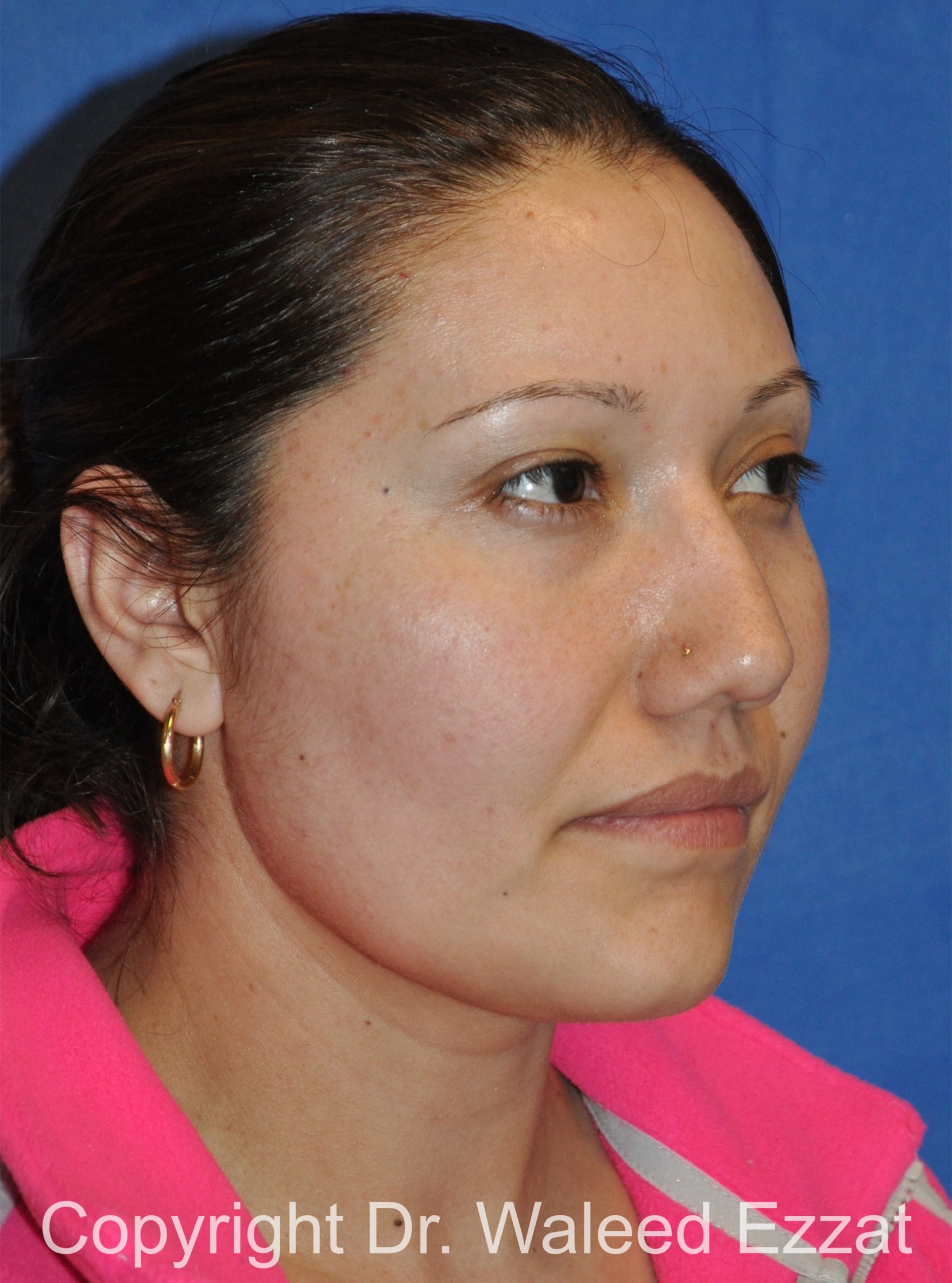 Reconstructive Rhinoplasty Patient Photo - Case 177 - after view-1