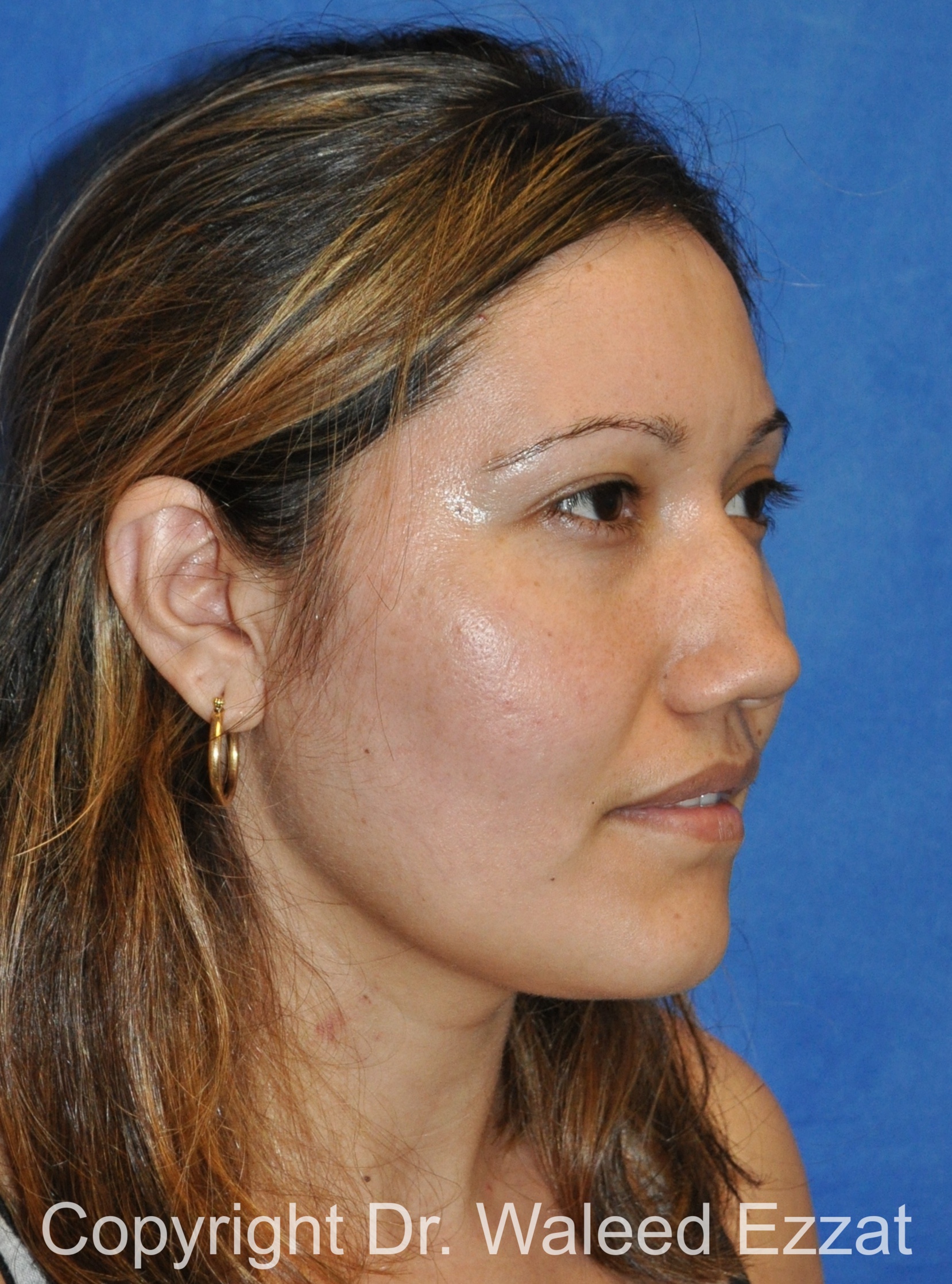 Reconstructive Rhinoplasty Patient Photo - Case 177 - before view-1