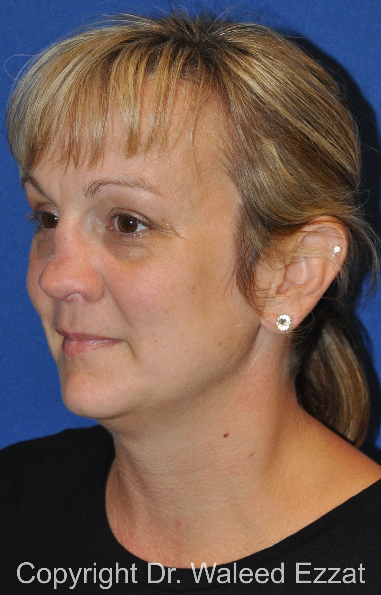 Reconstructive Rhinoplasty Patient Photo - Case 178 - before view-1