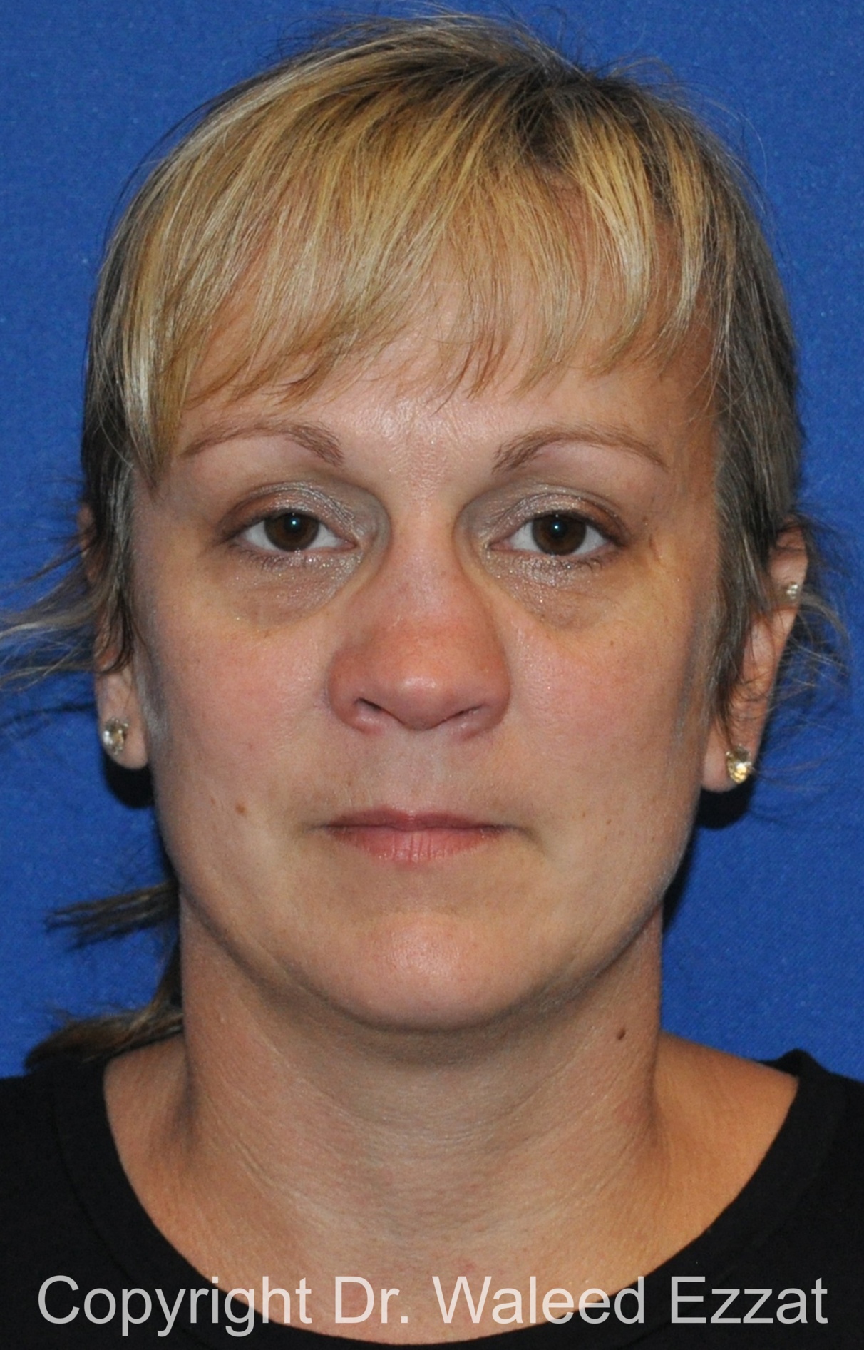 Reconstructive Rhinoplasty Patient Photo - Case 178 - before view-2