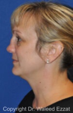 Reconstructive Rhinoplasty - Case 178 - Before