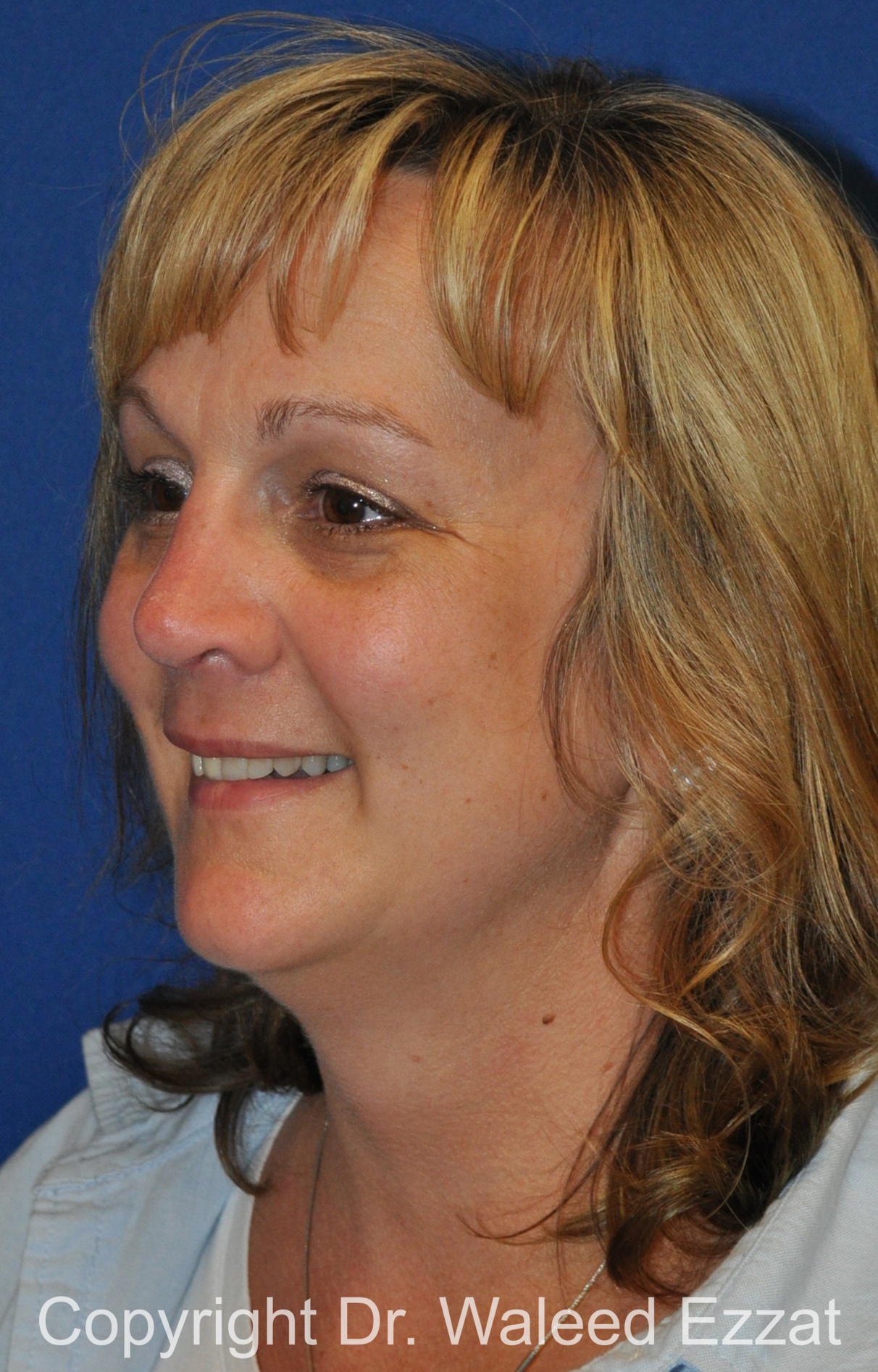 Reconstructive Rhinoplasty Patient Photo - Case 178 - after view-1