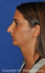Revision Rhinoplasty - Case 40 - Before