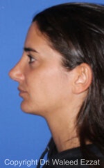Revision Rhinoplasty - Case 40 - After