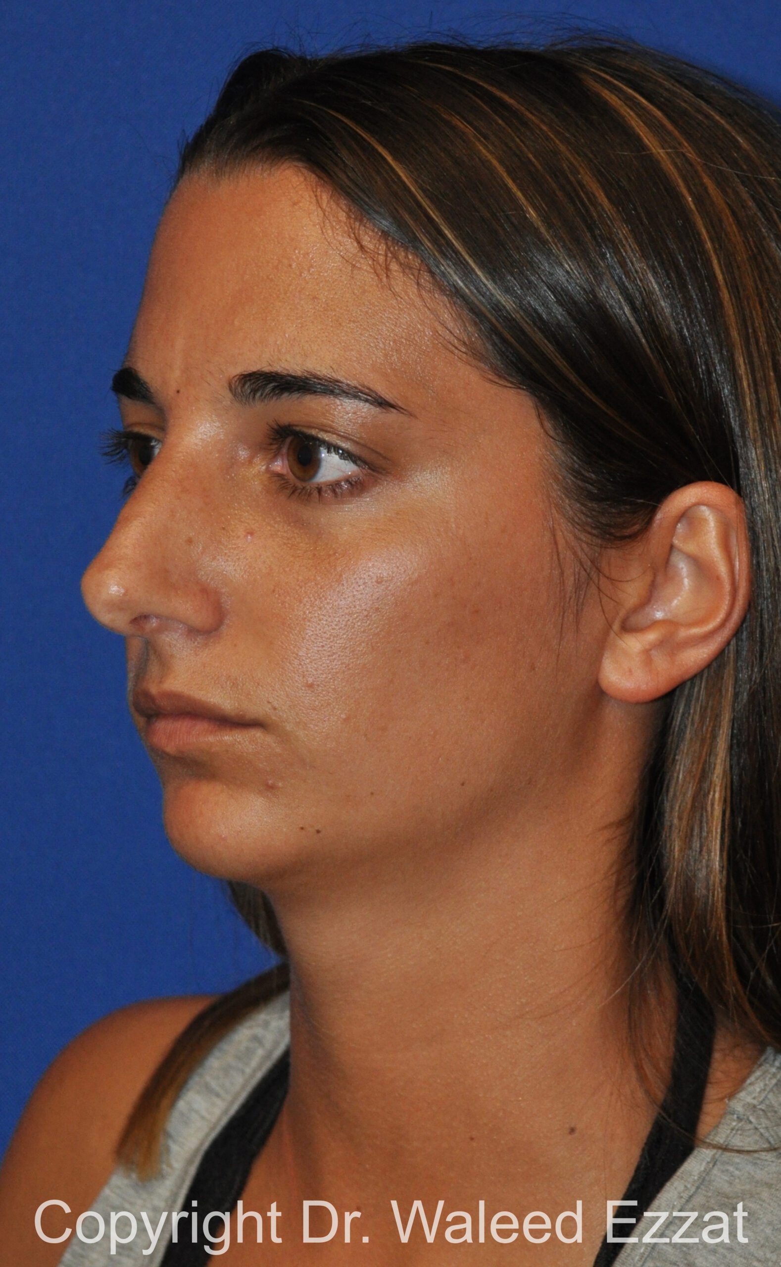 Revision Rhinoplasty Patient Photo - Case 40 - before view-1