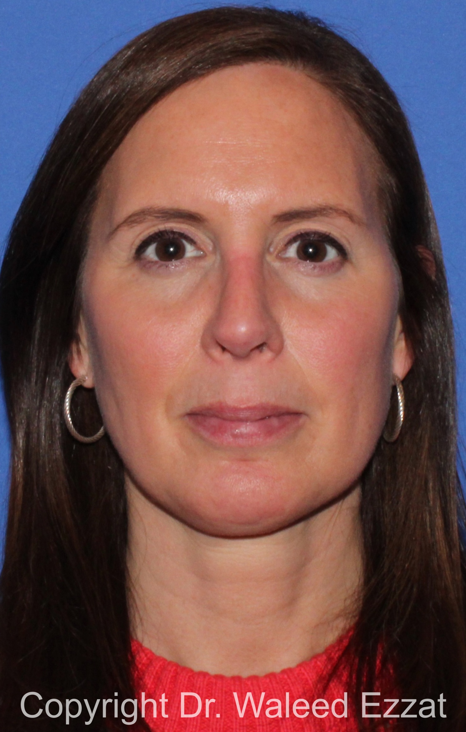 Revision Rhinoplasty Patient Photo - Case 500 - after view-2