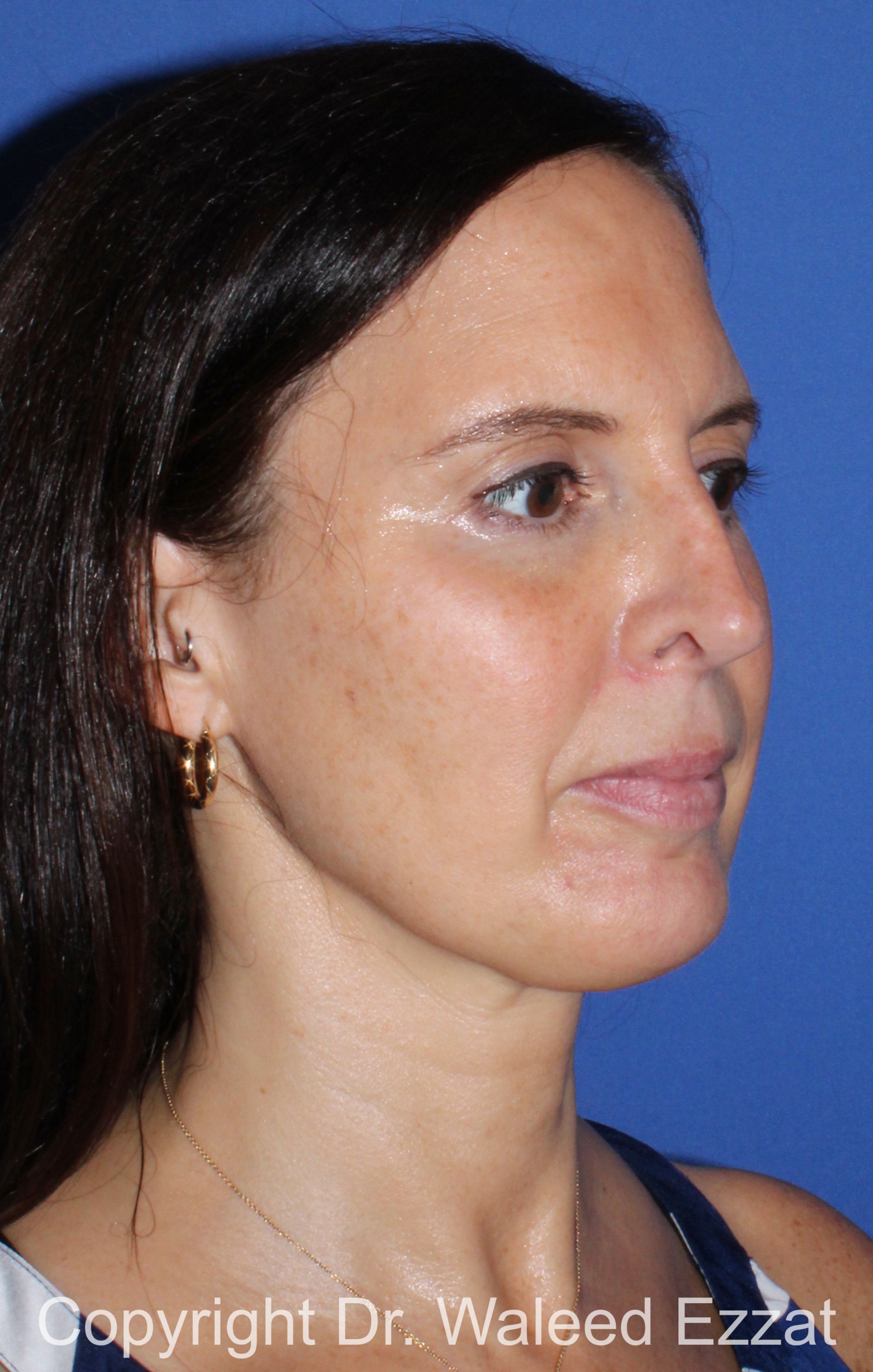 Revision Rhinoplasty Patient Photo - Case 500 - before view-1