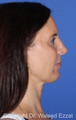 Revision Rhinoplasty - Case 500 - Before