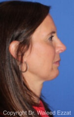 Revision Rhinoplasty - Case 500 - After