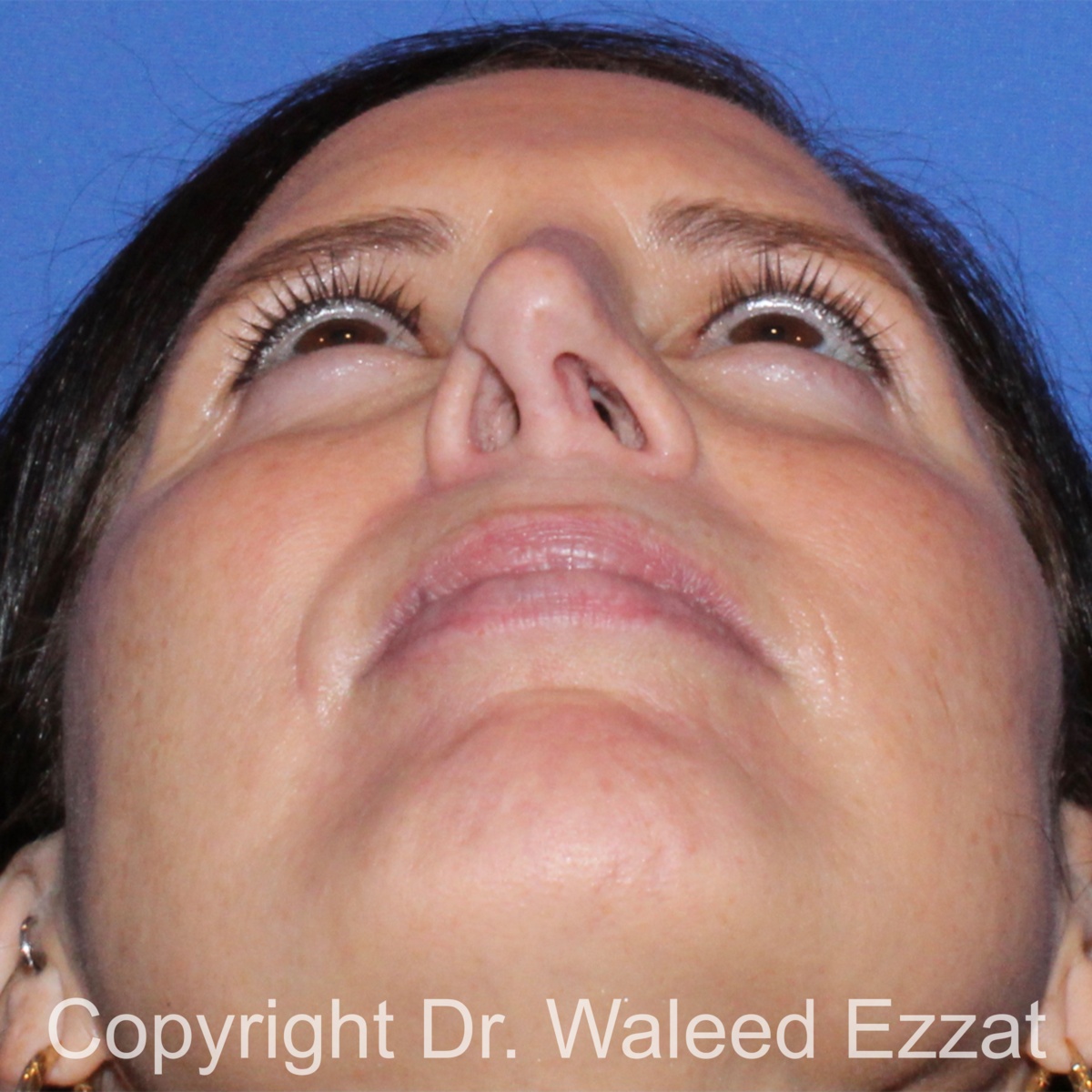 Revision Rhinoplasty Patient Photo - Case 500 - before view-3