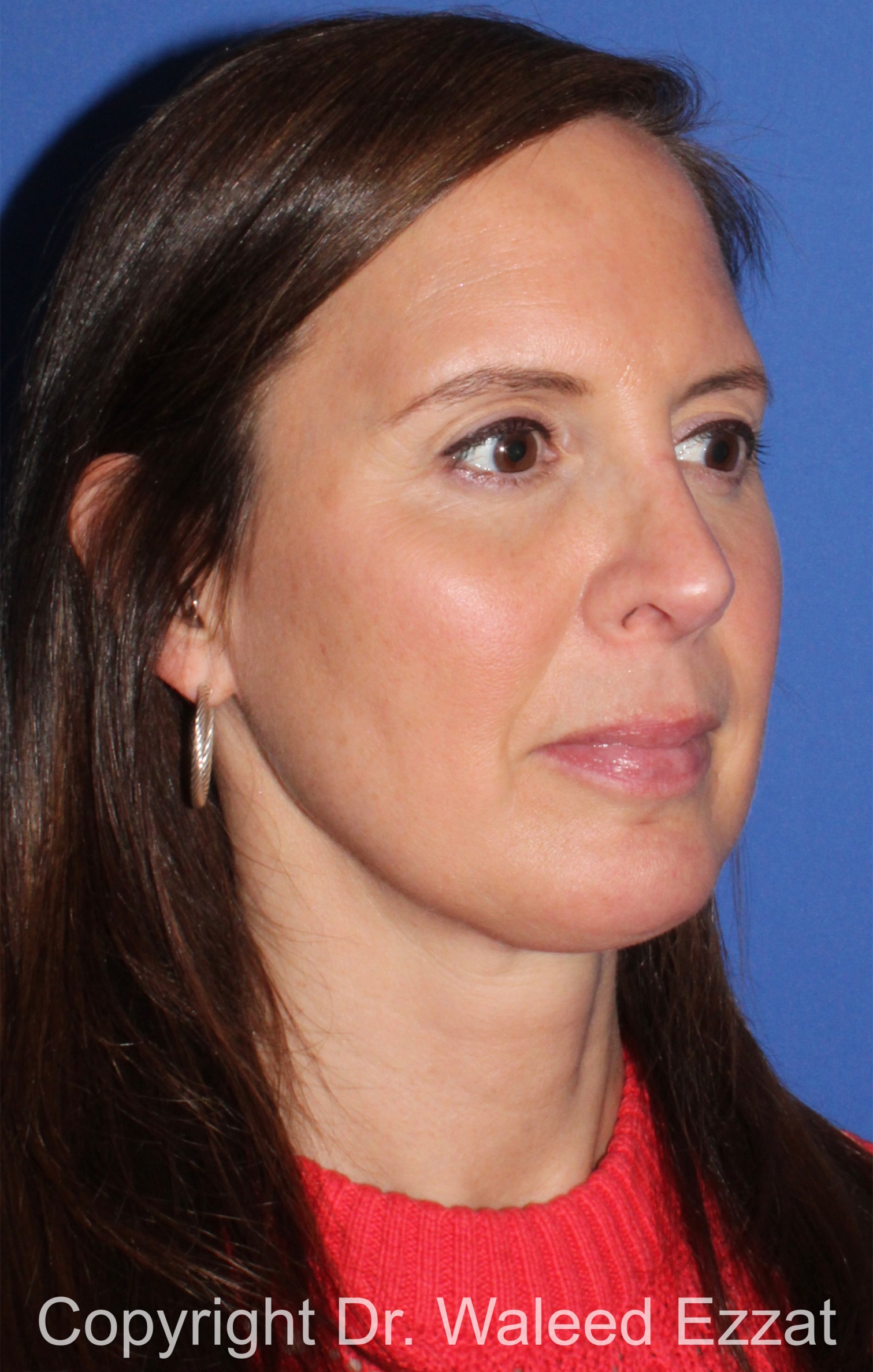 Revision Rhinoplasty Patient Photo - Case 500 - after view-1