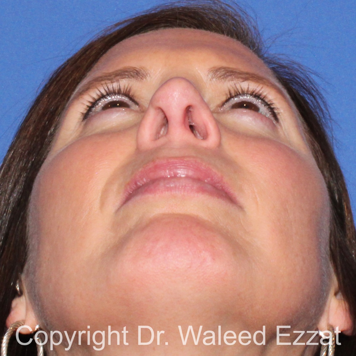 Revision Rhinoplasty Patient Photo - Case 500 - after view-3