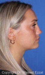 Revision Rhinoplasty - Case 501 - Before