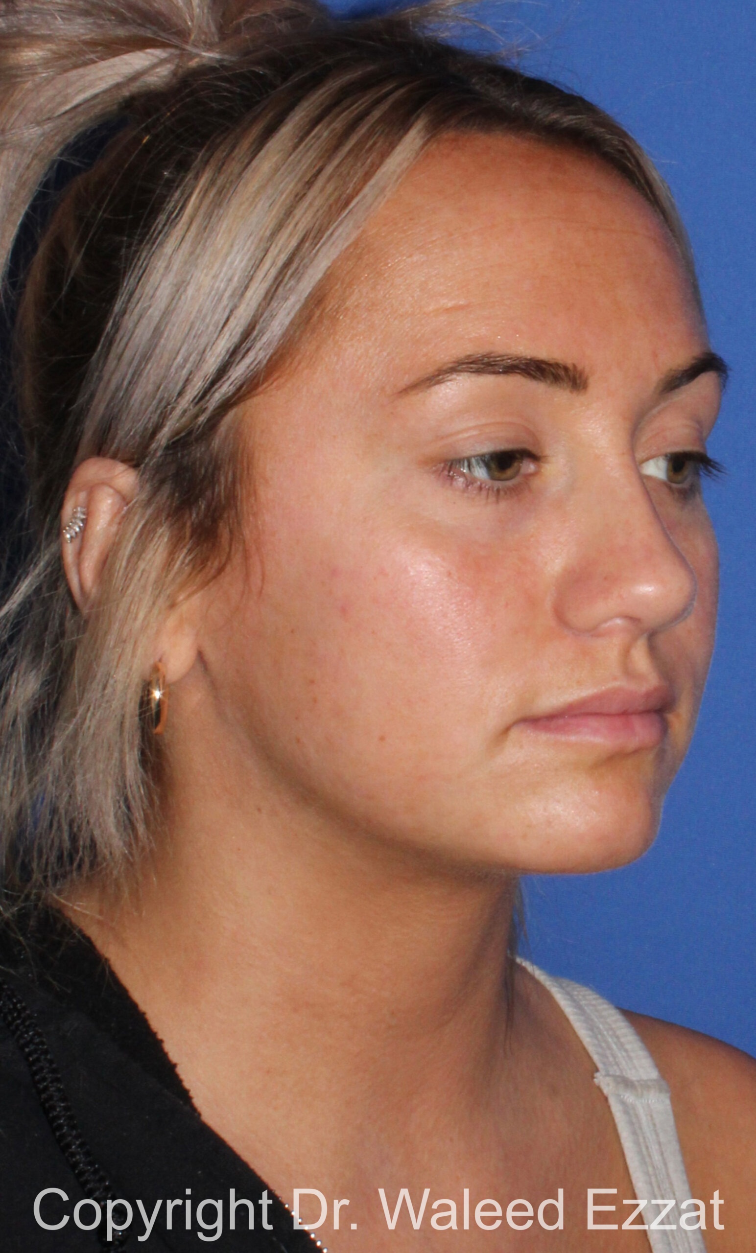 Revision Rhinoplasty Patient Photo - Case 501 - after view-1