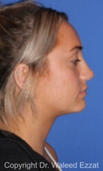 Revision Rhinoplasty - Case 501 - After