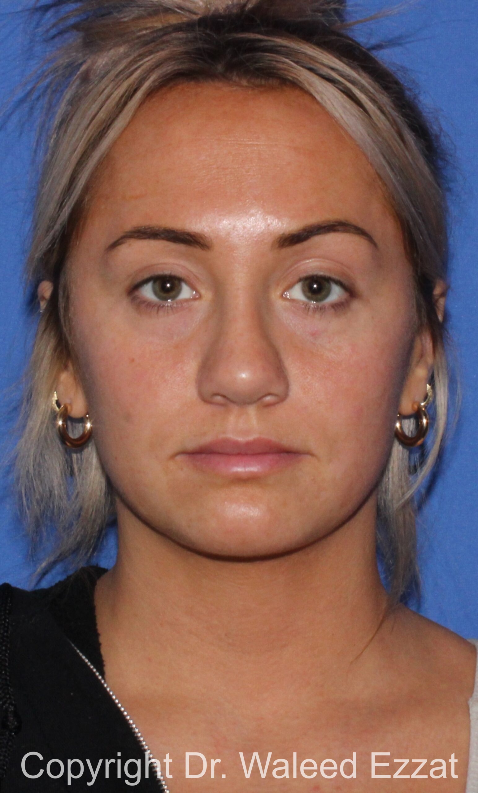 Revision Rhinoplasty Patient Photo - Case 501 - after view-2