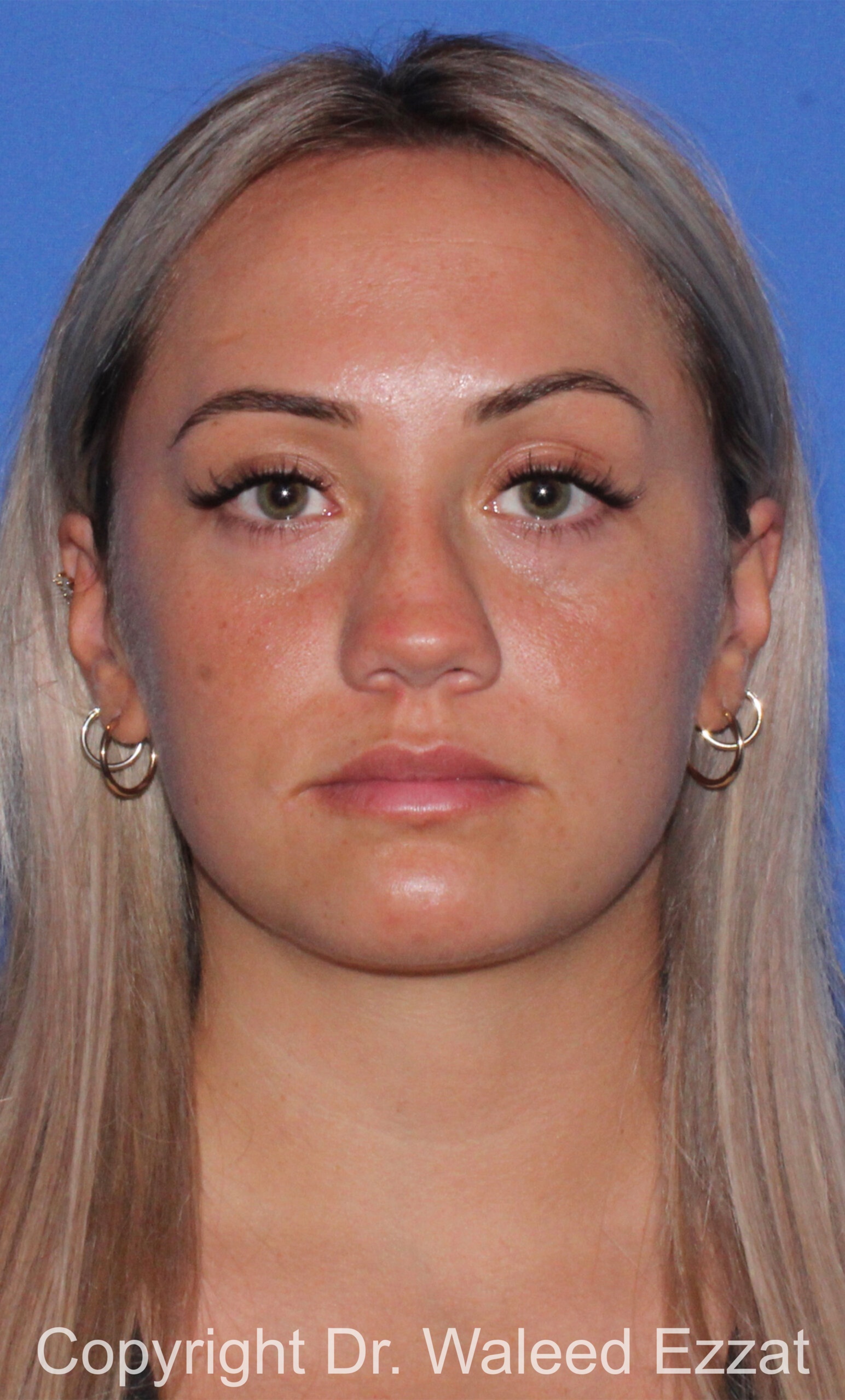 Revision Rhinoplasty Patient Photo - Case 501 - before view-2