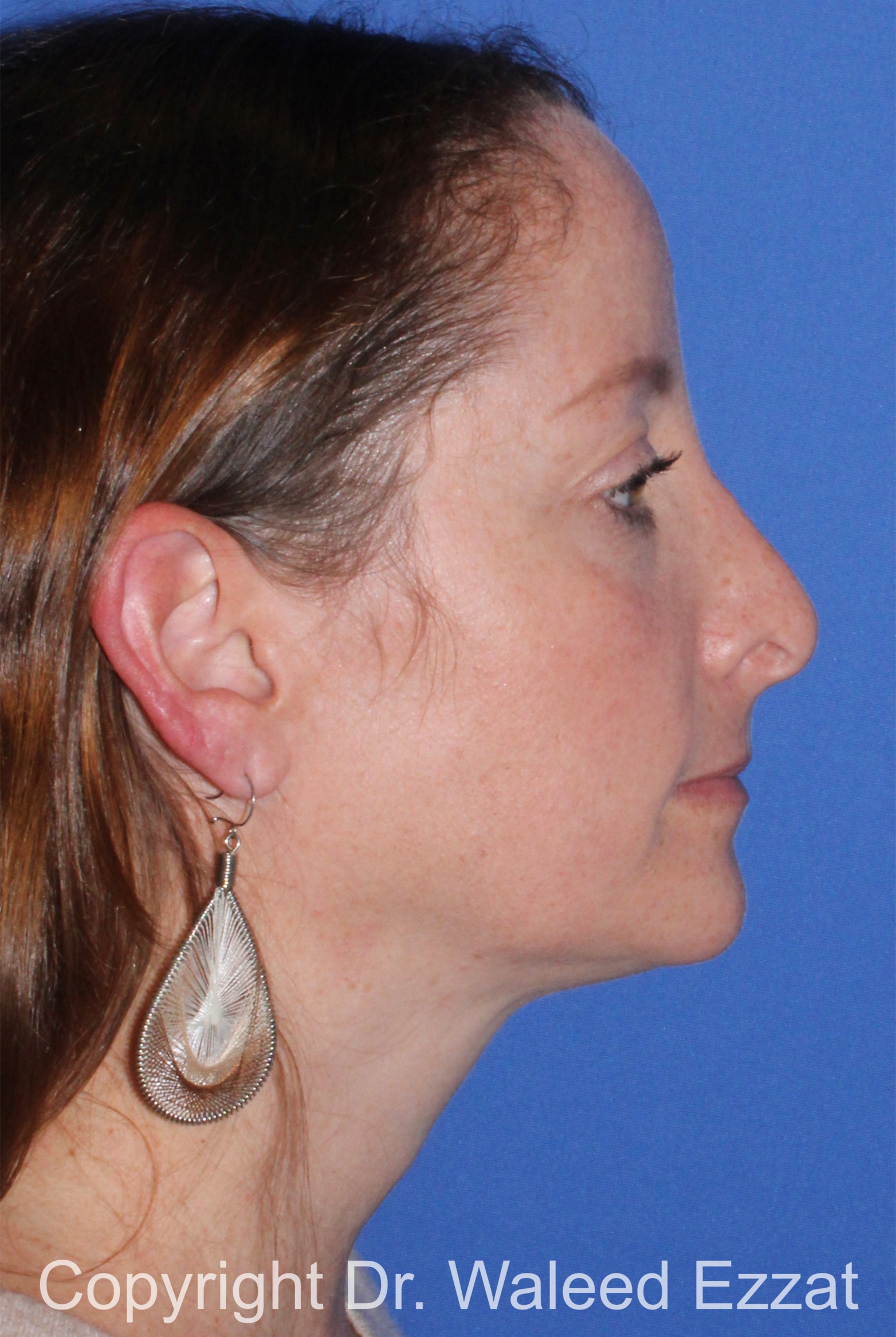 Revision Rhinoplasty Patient Photo - Case 502 - before view-