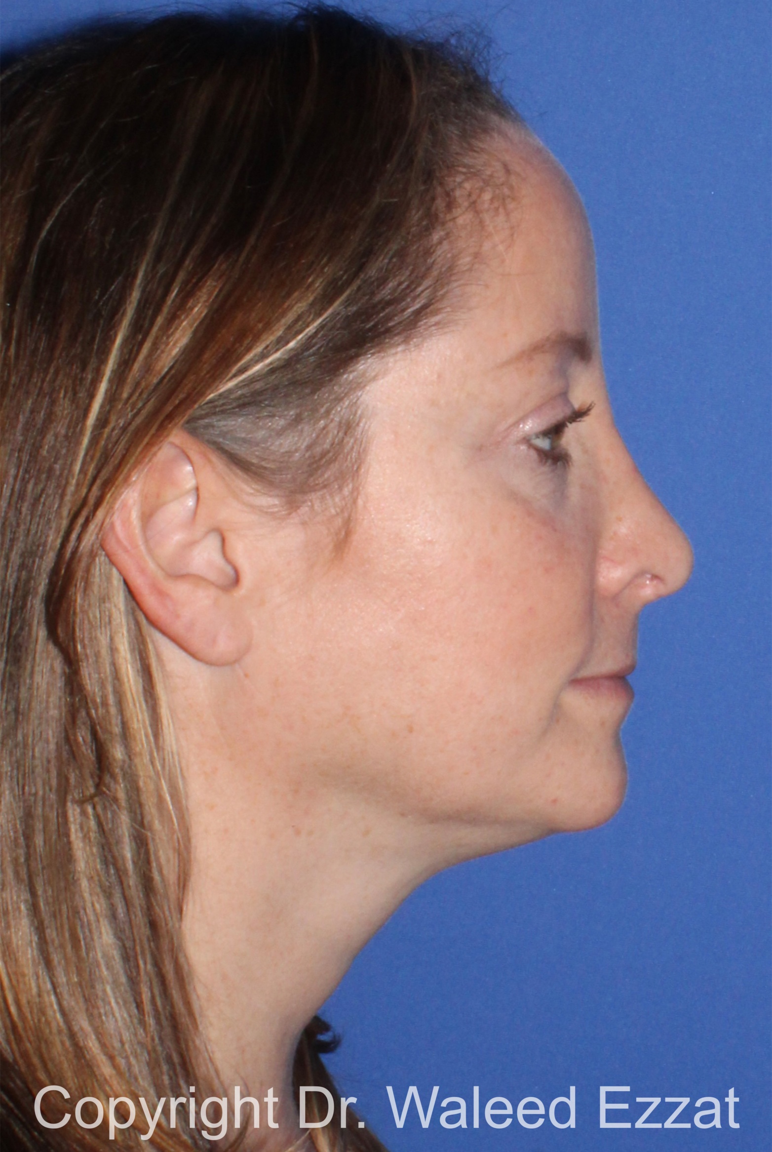 Revision Rhinoplasty Patient Photo - Case 502 - after view