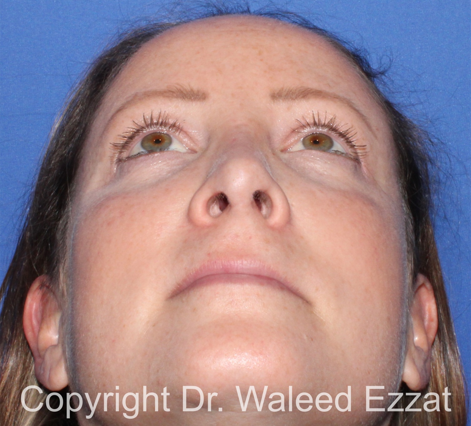Revision Rhinoplasty Patient Photo - Case 502 - after view-3