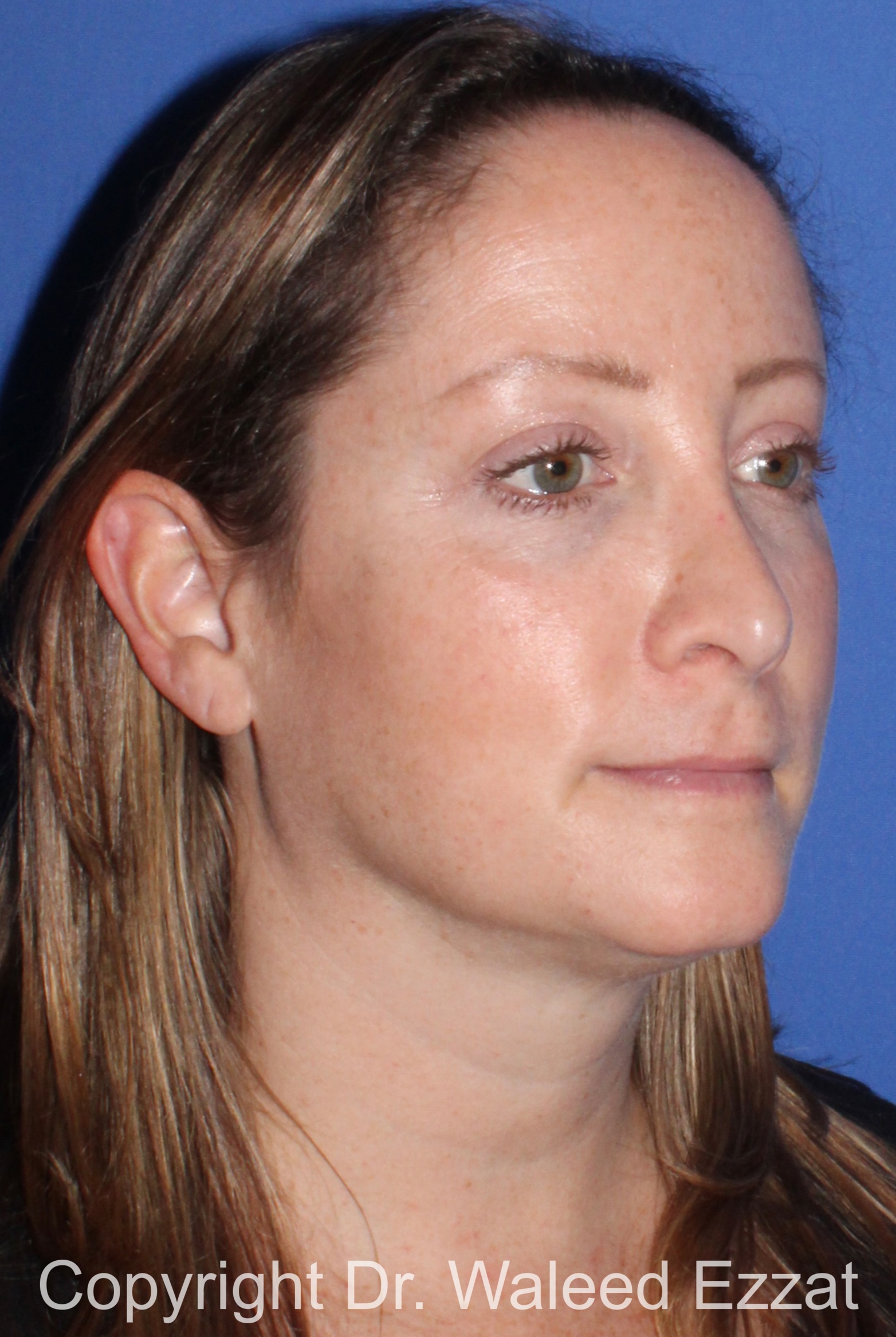 Revision Rhinoplasty Patient Photo - Case 502 - after view-1