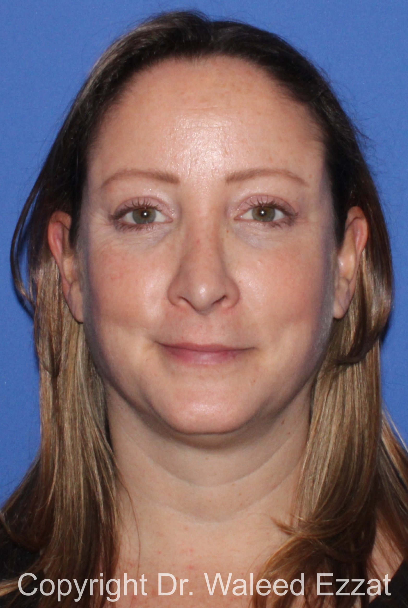 Revision Rhinoplasty Patient Photo - Case 502 - after view-2