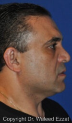 Male Rhinoplasty - Case 503 - Before