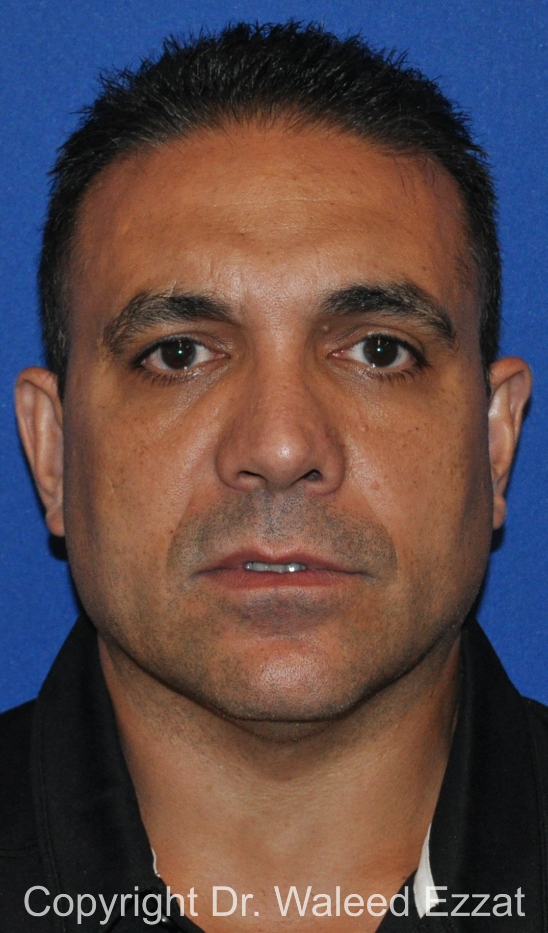 Revision Rhinoplasty Patient Photo - Case 503 - after view-2