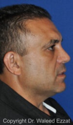 Male Rhinoplasty - Case 503 - After